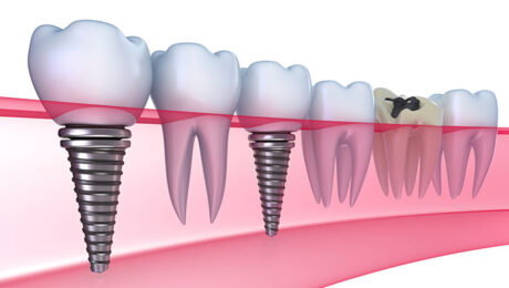 The-Importance-of-Ultrasonic-Cleaning-in-Dental-Industry